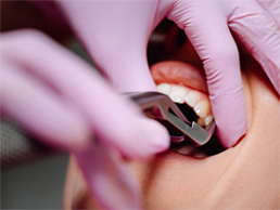 Tooth Extractions